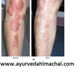 AROGYAM PURE HERBS KIT FOR PSORIASIS